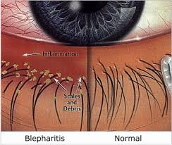 Blepharitis