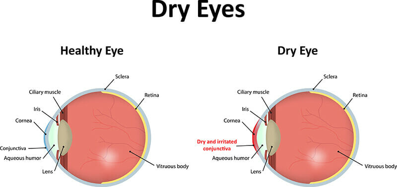 Dry Eye