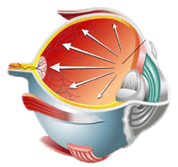 glaucoma