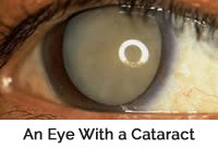 mature_cataract_with-caption