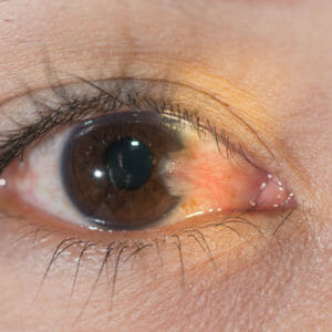 Pterygium