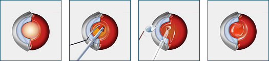 cataract_surgery_new