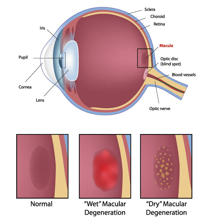 Macular Degeneration