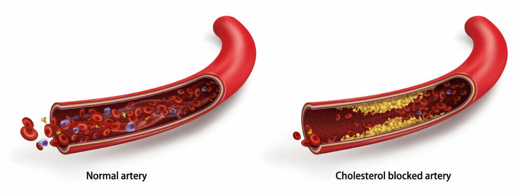 Normal Artery vs Cholesterol Blocked Artery