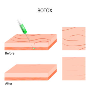 BOTOX before and after