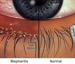 picture of blepharitis