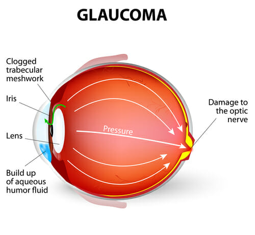 Anatomy of glaucoma